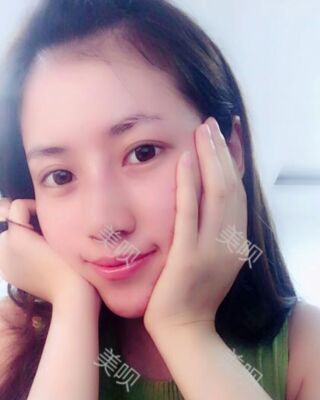福州爱美尔假体隆鼻失败后成功修复果图