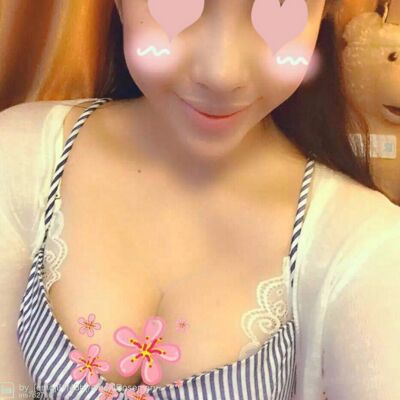 自体脂肪丰胸对比照片，福州爱美尔张胜利做的