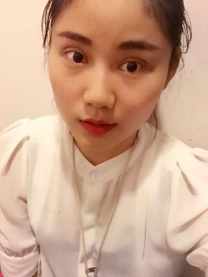 福州爱美尔切开双眼皮消肿过程图分享