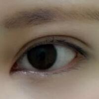 开内眼角割双眼皮恢复全过程和图片分享