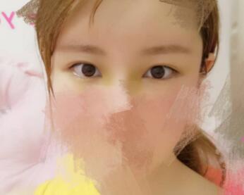 开内眼角割双眼皮恢复全过程和图片分享，双眼皮多项整形整形