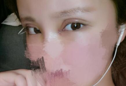 开内眼角割双眼皮恢复全过程和图片分享，双眼皮多项整形整形