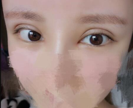 开内眼角割双眼皮恢复全过程和图片分享，双眼皮多项整形整形