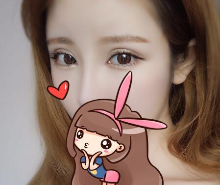 开内眼角割双眼皮恢复全过程和图片分享，双眼皮多项整形整形