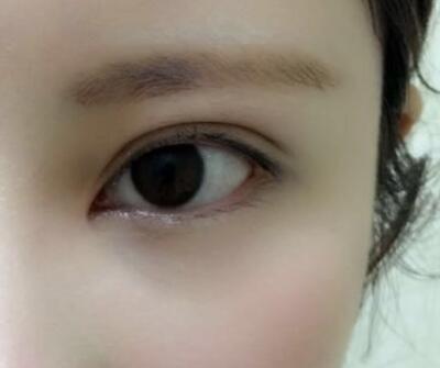 开内眼角割双眼皮恢复全过程和图片分享，双眼皮多项整形整形