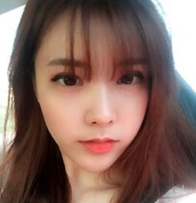 做了割双眼皮和开内眼角双眼皮多项整形整形手术，恢复图片日志分享