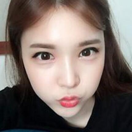 做了割双眼皮和开内眼角双眼皮多项整形整形手术，恢复图片日志分享