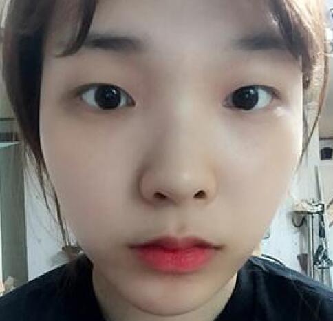 做了割双眼皮和开内眼角双眼皮多项整形整形手术，恢复图片日志分享