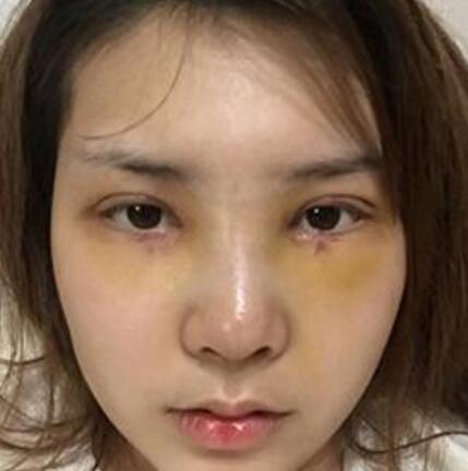 做了割双眼皮和开内眼角双眼皮多项整形整形手术，恢复图片日志分享