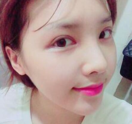 做了割双眼皮和开内眼角双眼皮多项整形整形手术，恢复图片日志分享