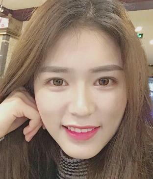 广州凯美达皮肤美容激光祛斑前后对比