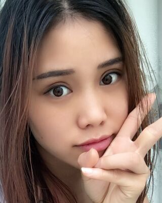 双眼皮失败修复果图，福州爱美尔王召克做的