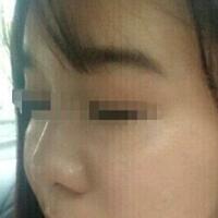 在济南吉芙医院做的玻尿酸填充泪沟，填充泪沟图片分享