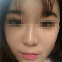 在济南吉芙医院做的玻尿酸填充泪沟，填充泪沟图片分享