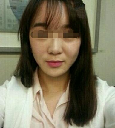 在济南吉芙医院做的玻尿酸填充泪沟，填充泪沟图片分享