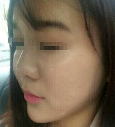 在济南吉芙医院做的玻尿酸填充泪沟，填充泪沟图片分享