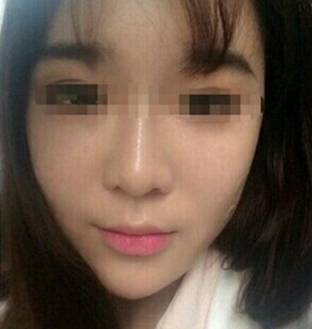 在济南吉芙医院做的玻尿酸填充泪沟，填充泪沟图片分享