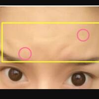 注射瘦脸去抬头纹果不错——济南吉芙美容整形医院