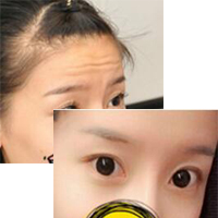 注射瘦脸去抬头纹果不错——济南吉芙美容整形医院