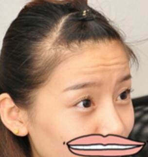 注射瘦脸去抬头纹果不错——济南吉芙美容整形医院