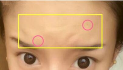 注射瘦脸去抬头纹果不错——济南吉芙美容整形医院