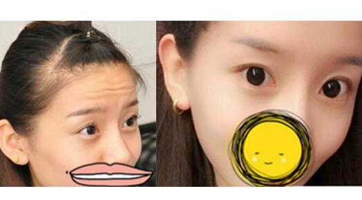 注射瘦脸去抬头纹果不错——济南吉芙美容整形医院