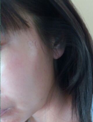 激光去咖啡斑恢复过程，福州美贝尔真实案例