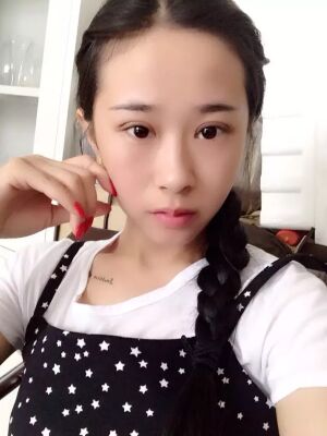 福州美贝尔切开双眼皮成功案例前后对比图