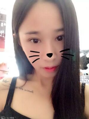 福州美贝尔切开双眼皮成功案例前后对比图