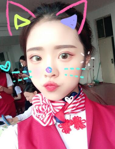 上海澳雅邝勇韩式全切双眼皮恢复过程图