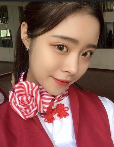 上海澳雅邝勇韩式全切双眼皮恢复过程图