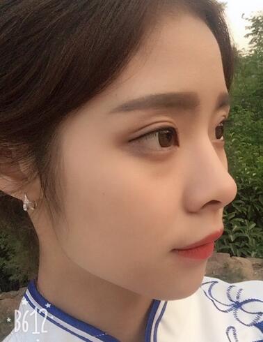 上海澳雅邝勇韩式全切双眼皮恢复过程图