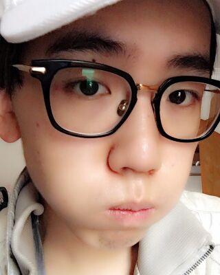 男生隆鼻整形案例分享，福州美贝尔张潮做的