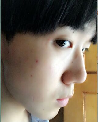 男生隆鼻整形案例分享，福州美贝尔张潮做的