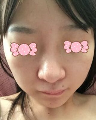 第(一)次激光去雀斑果图，贵阳美莱刘红武做的