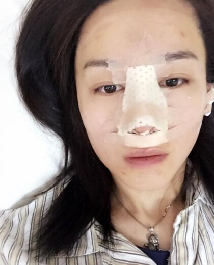 哈尔滨假体隆鼻价格8900元，隆鼻真实案例分享