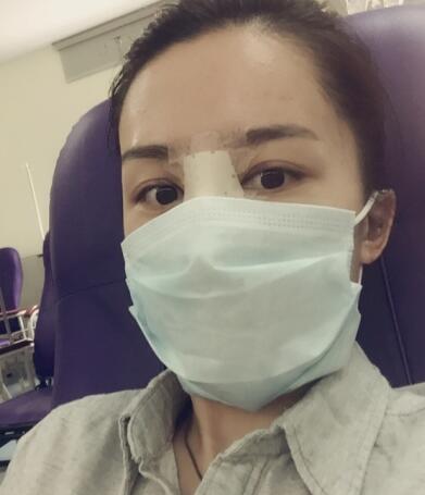哈尔滨假体隆鼻价格8900元，隆鼻真实案例分享