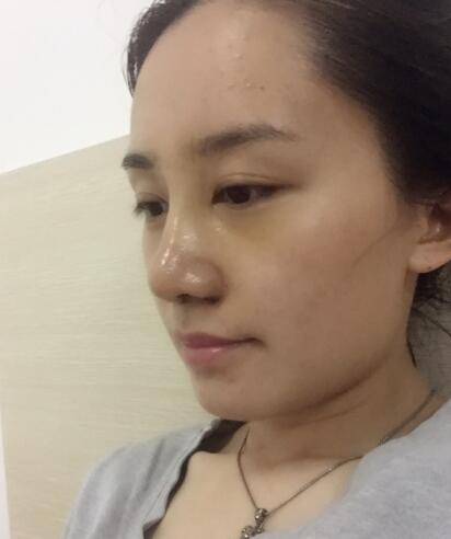 哈尔滨假体隆鼻价格8900元，隆鼻真实案例分享