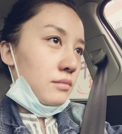 哈尔滨假体隆鼻价格8900元，隆鼻真实案例分享