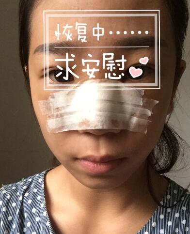 假体隆鼻术后注意事项和恢复过程图分享
