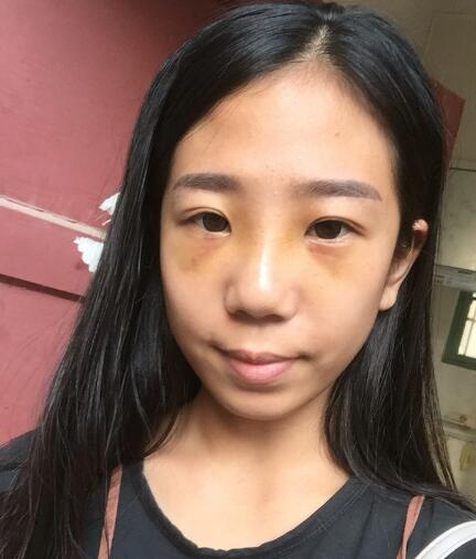 假体隆鼻术后注意事项和恢复过程图分享
