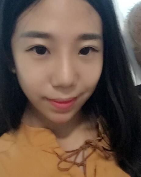 假体隆鼻术后注意事项和恢复过程图分享