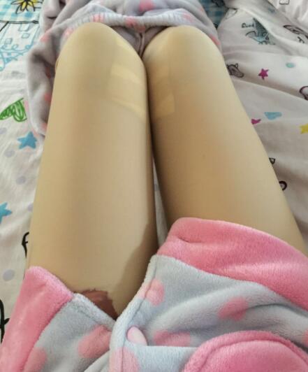 吸脂塑身医院推荐欧兰仁美医院，吸脂瘦腿恢复图分享