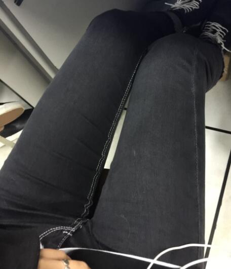 吸脂塑身医院推荐欧兰仁美医院，吸脂瘦腿恢复图分享