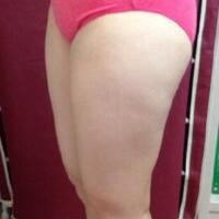 抽脂减肥瘦大腿价格10800元，一个月后恢复很好