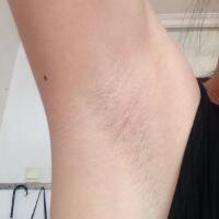 激光脱毛的价格380元，图片分享