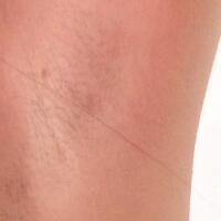 激光脱毛的价格380元，图片分享