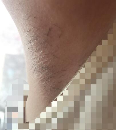 激光脱毛的价格380元,激光脱毛图片分享