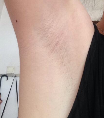 激光脱毛的价格380元,激光脱毛图片分享