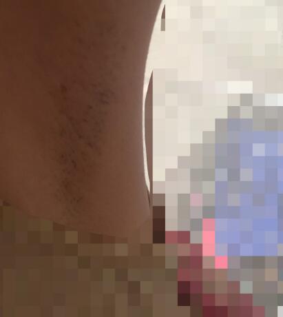 激光脱毛的价格380元,激光脱毛图片分享